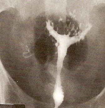 adenomyose 6