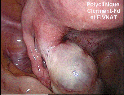 endometriose endometriome