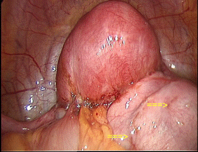 endometriose pelvis bloque